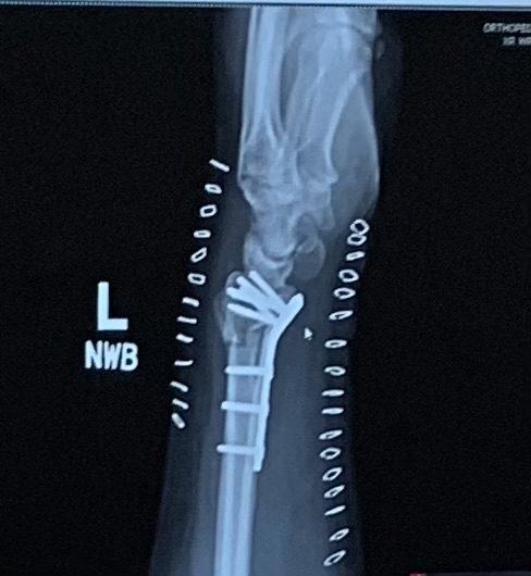 Broken Wrist Surgery Update – And I’m Starting to Paint Again!